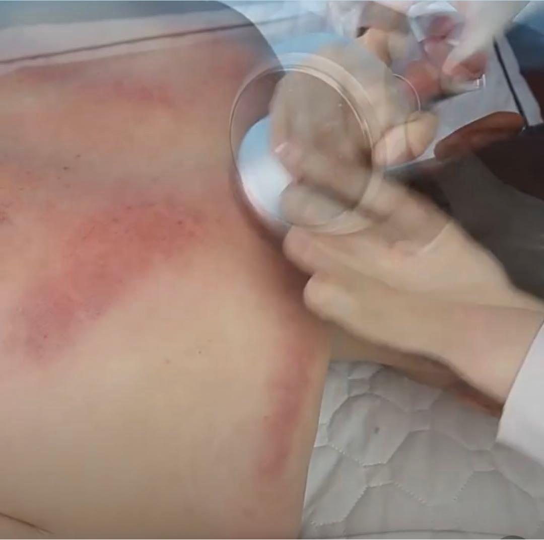 6in1 2023年最新脂肪溶解リポレーザー &80kキャビテーション RF